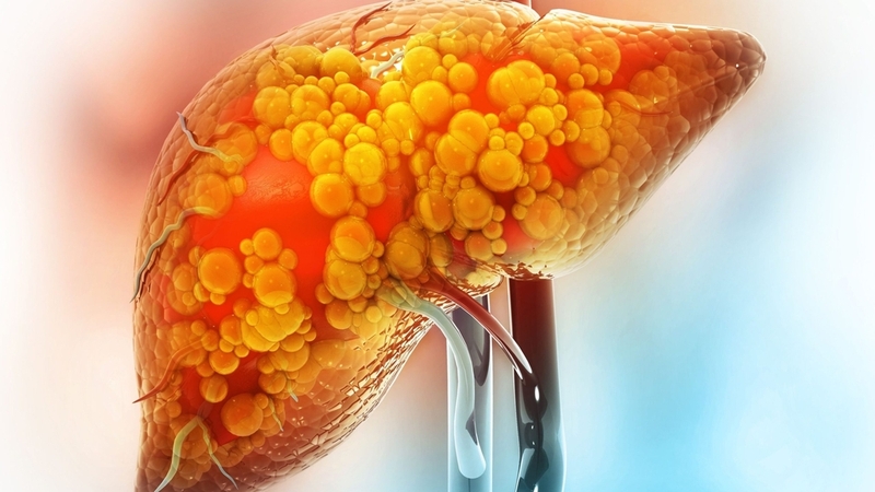 Rối loạn lipid máu có nguy hiểm không​? Các biến chứng gây ra bởi rối loạn lipid máu 3