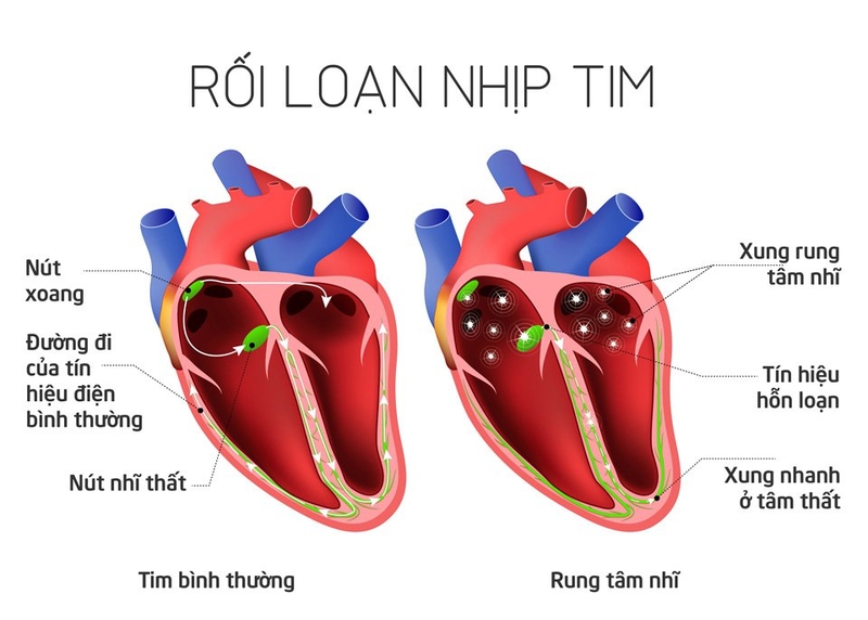 Phương pháp điều trị rối loạn nhịp tim hiệu quả