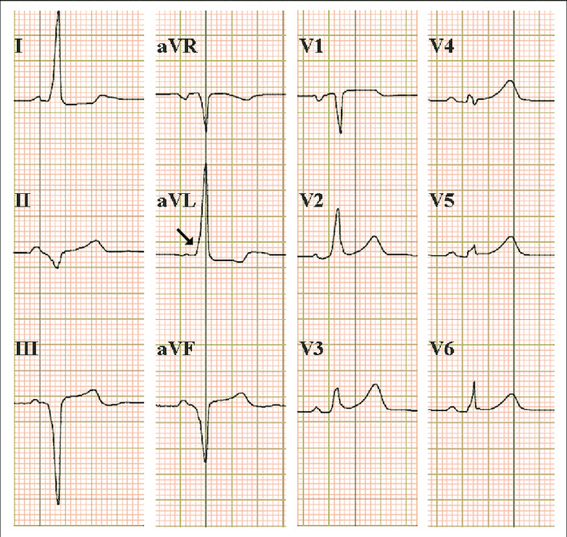 Rối loạn nhịp tim nhanh trên thất: Nguyên nhân và cách điều trị hiệu quả 2