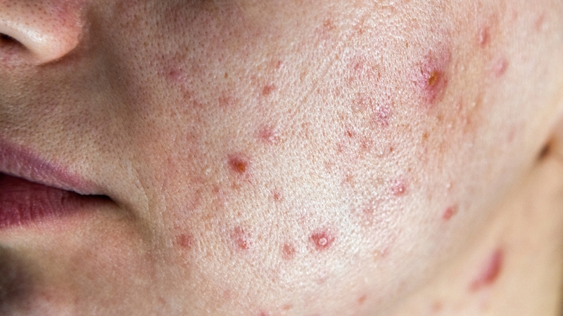 Rối loạn nội tiết tố nữ là gì? Nguyên nhân, dấu hiệu, phương pháp chẩn đoán và điều trị 3