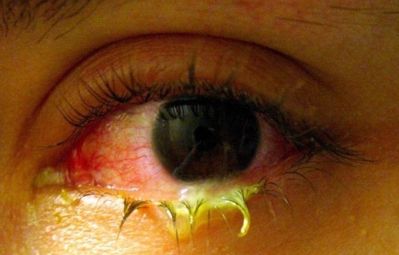 Rối loạn tuyến lệ: Nguyên nhân, triệu chứng, cách điều trị bệnh hiệu quả 3