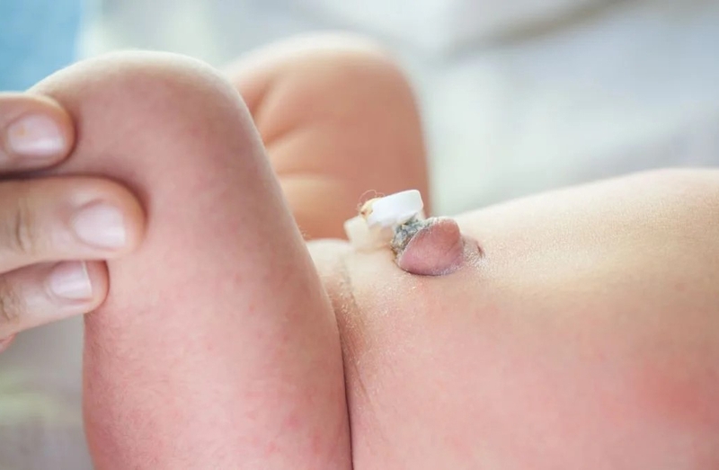 Rốn lồi bất thường ở trẻ do nguyên nhân gì? Có thể tự khỏi không? 2