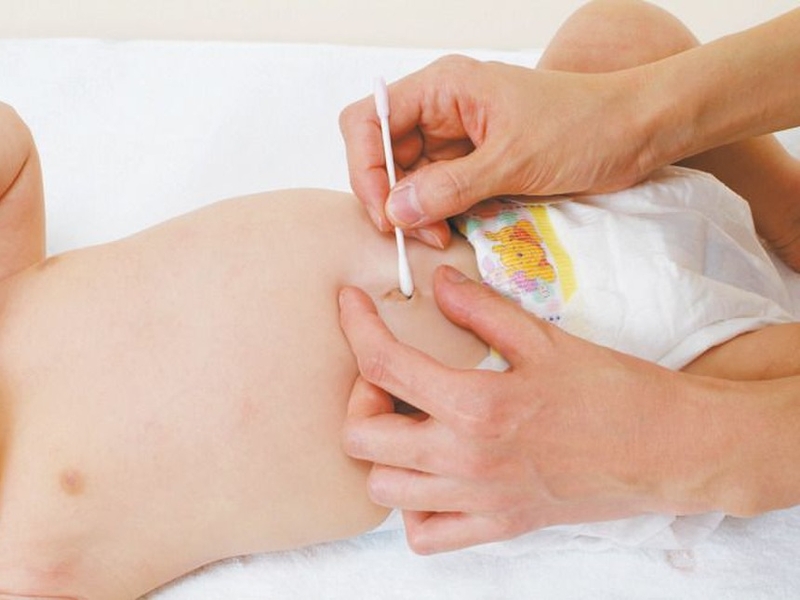 U hạt rốn ở trẻ sơ sinh và những điều cần biết 3