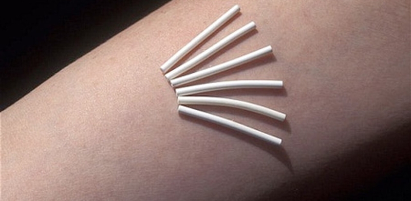 Để tránh tình trạng rong kinh, bạn nên chọn que cấy tránh thai tại cơ sở y tế uy tín