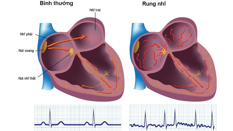 Rung nhĩ đơn độc và điều cần biết đối với người bệnh tim mạch 2