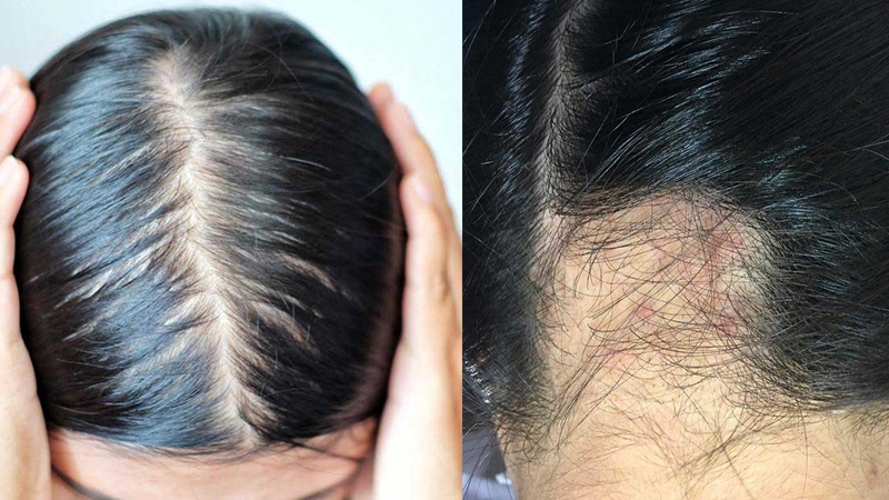 Rụng tóc có sẹo là gì? Hướng dẫn phân biệt rụng tóc có sẹo và rụng tóc không sẹo 3