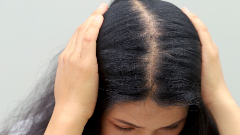 Nhiều người lo lắng&nbsp;rụng tóc nhiều ở nữ tuổi 14 có sao không