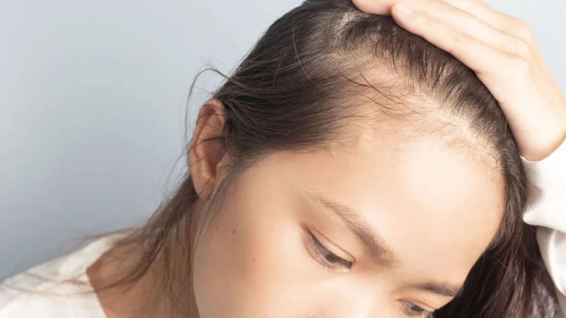 Căng thẳng học tập và thiếu ngủ cũng có thể khiến tóc rụng nhiều hơn