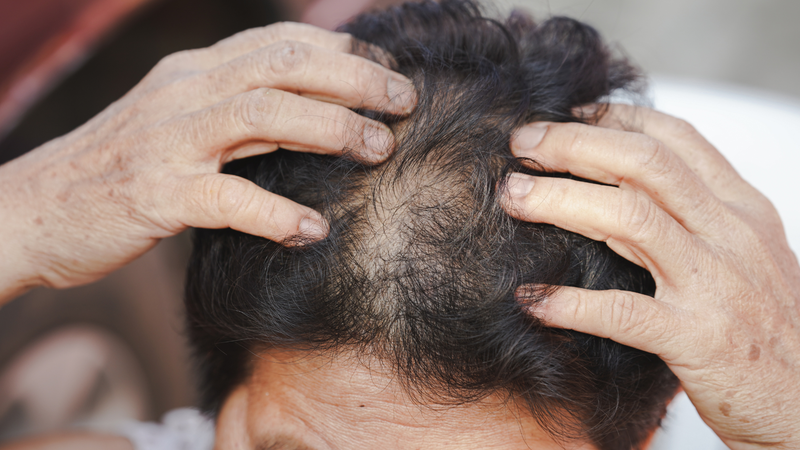 Sự thay đổi hormone ở tuổi trung niên có thể làm tóc yếu và dễ rụng hơn