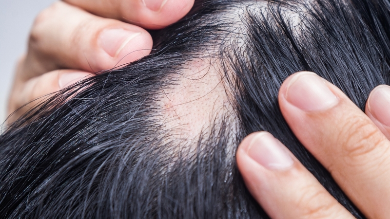 Tìm hiểu nguyên nhân gây ra tình trạng tóc rụng từng mảng