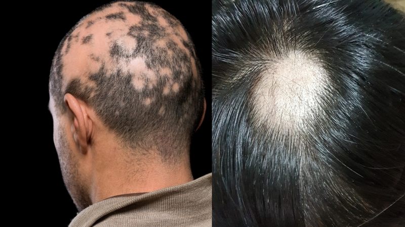 Rụng tóc từng mảng tạo thành các mảng tròn hoặc oval nhẵn bóng hiện rõ trên da đầu