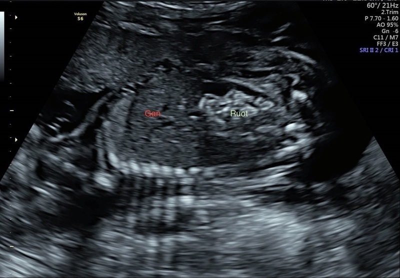 Ruột phản âm sáng độ 2 là gì là câu hỏi thắc mắc của nhiều phụ huynh