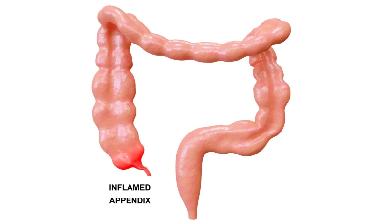 Ruột thừa nằm bên nào? Dấu hiệu nhận biết đau ruột thừa 3