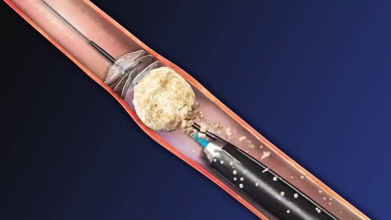 Sonde JJ niệu quản là gì? Rút ống JJ niệu quản có đau không? 2