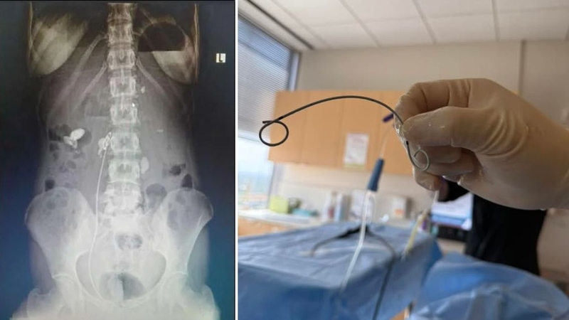 Thủ thuật rút ống JJ thường diễn ra nhanh chóng và chỉ gây khó chịu nhẹ