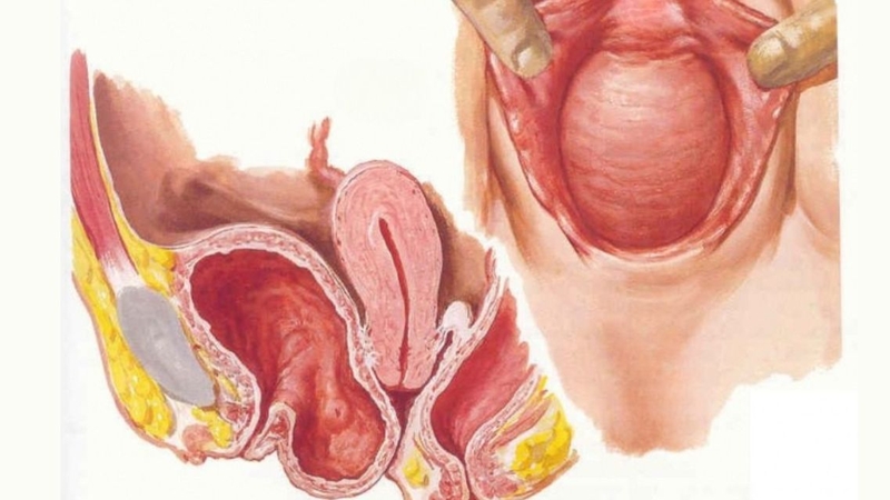 Sa bàng quang là tình trạng không ít phụ nữ đang gặp phải