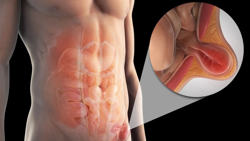 Sa đì cần được thăm khám để xác định chính xác nguyên nhân