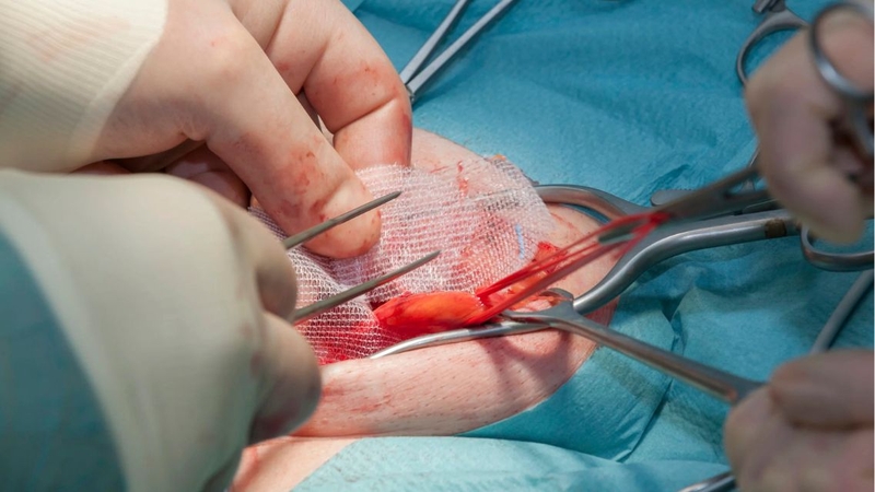 Thoát vị bẹn ở nam giới có thể lan xuống vùng bìu