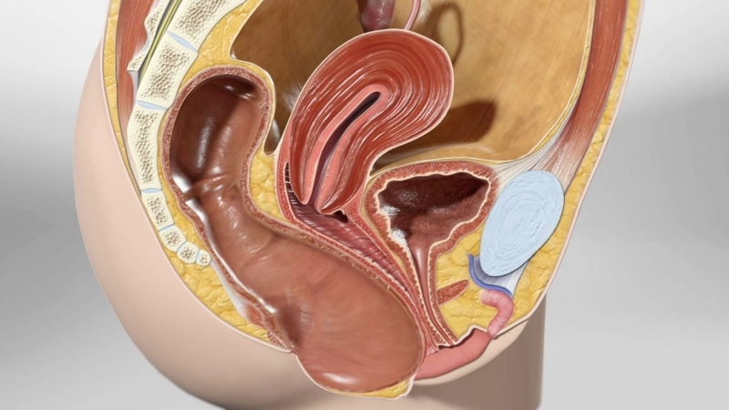 Sa trực tràng kiểu túi là gì? Triệu chứng và cách điều trị 3