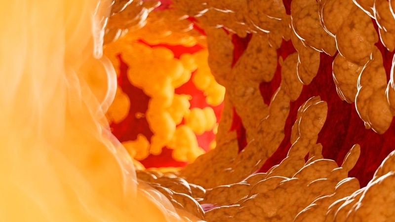 Sai lầm điều trị mỡ máu – Cảnh báo từ bác sĩ chuyên khoa 1