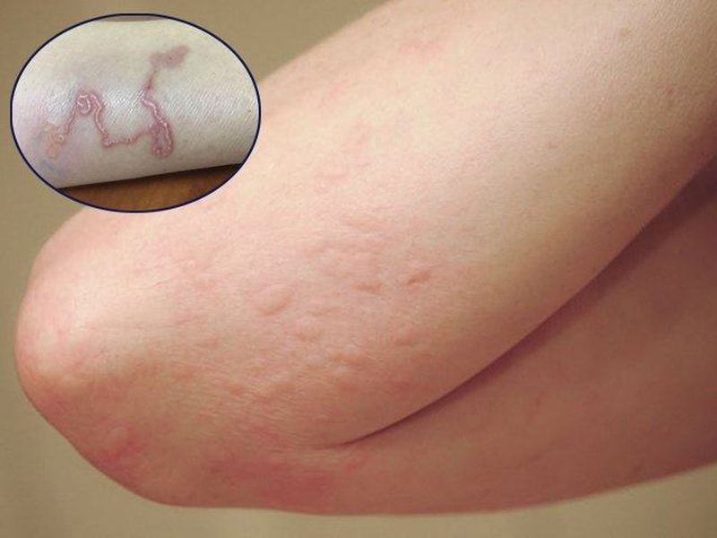 nhiem-san-cho-co-lay-tu-nguoi-sang-nguoi-khong-dau-hieu-nhan-biet-la-gi-1