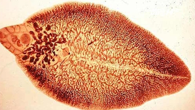 Sán lá gan lớn: Nguyên nhân, triệu chứng và chẩn đoán