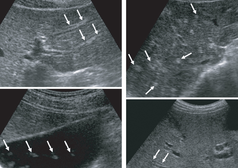 Sán lá gan lớn: Nguyên nhân, triệu chứng và chẩn đoán 4