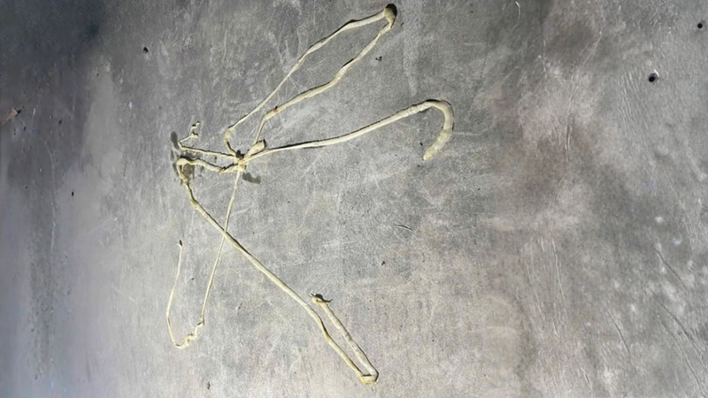 Sán lợn là nguyên nhân hình thành khối ký sinh trùng dài gần 10m