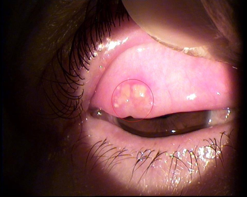 Sạn vôi ở mắt 1