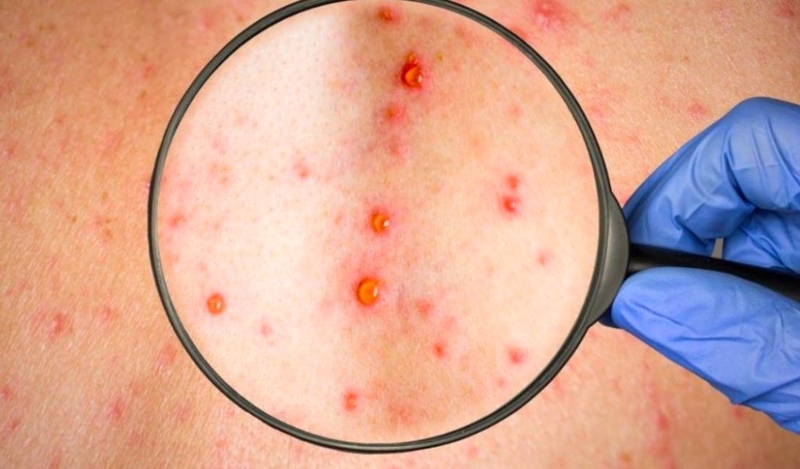 Săng giang mai là gì? Săng giang mai có ngứa không? 1