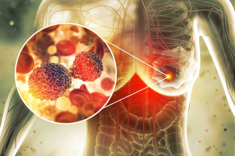 Sàng lọc ung thư vú - Liệu có cần thiết hay không? 1