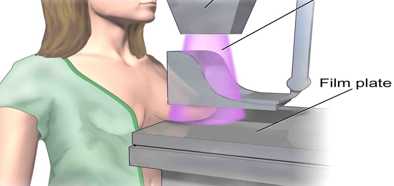 Sàng lọc ung thư vú - Liệu có cần thiết hay không? 3