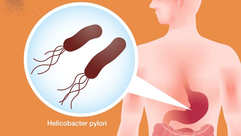 Sáng ngủ dậy bị ợ chua có sao không? Khi nào là vấn đề sức khỏe nghiêm trọng? 3