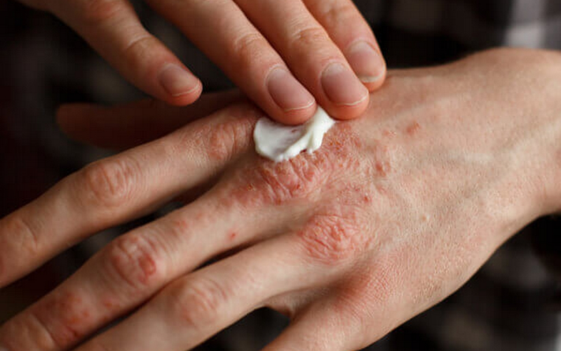 sao de tri vay nen o mui 2.png