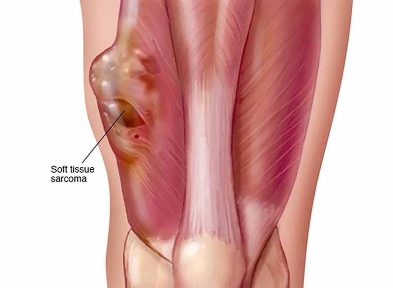 Sarcoma cơ vân ở trẻ em: Khái niệm, phân loại và mô tả 1