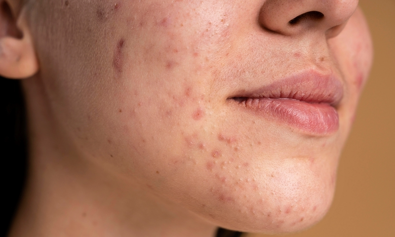 sau-30-tuoi-van-bi-mun-nguyen-nhan-va-cach-khac-phuc-mun 1