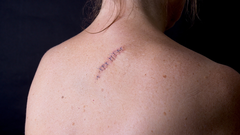 Sẹo là một trong những vấn đề khiến nhiều người lo lắng sau khi phẫu thuật hoặc khâu vết thương