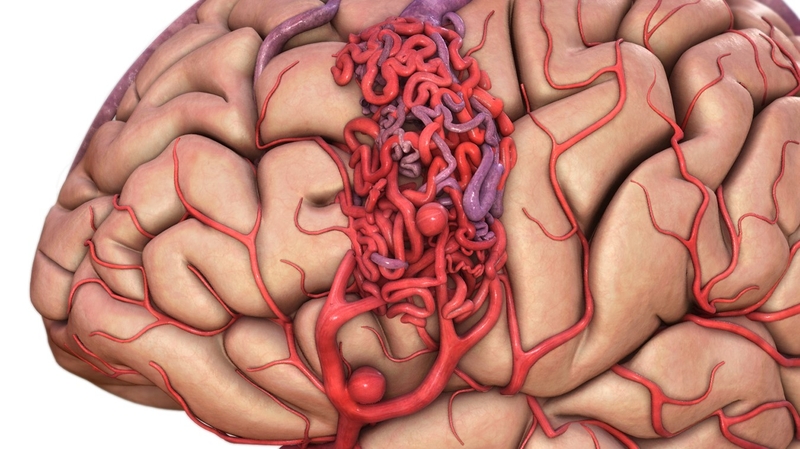 Sau điều trị dị dạng mạch máu não có tái phát không?0