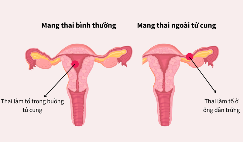 Sau khi đặt vòng tránh thai bị ra máu nhiều có bình thường không? 3