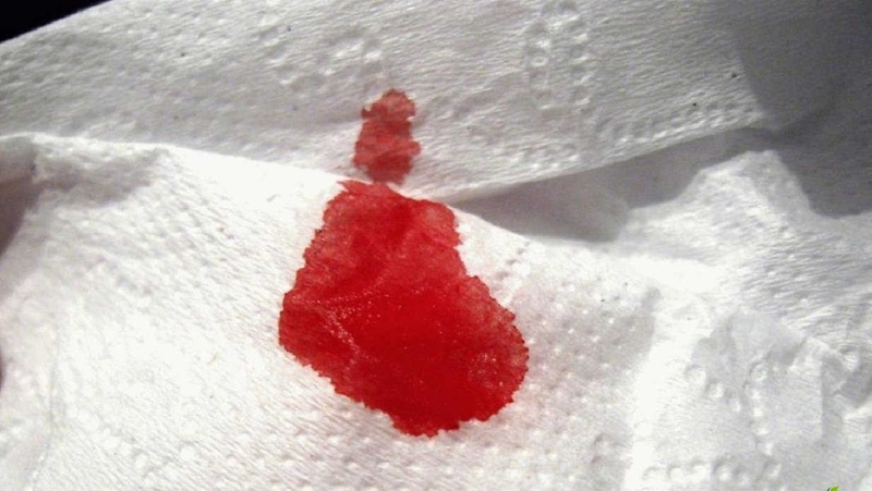 Sau khi đốt viêm lộ tuyến ra dịch vàng có bình thường không? 1