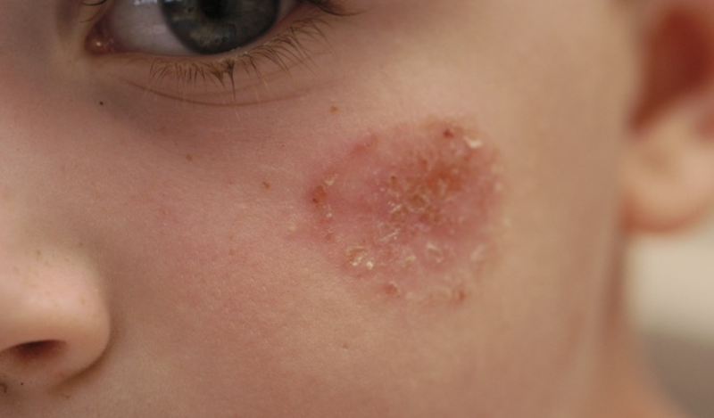 chốc lở có để lại sẹo không?