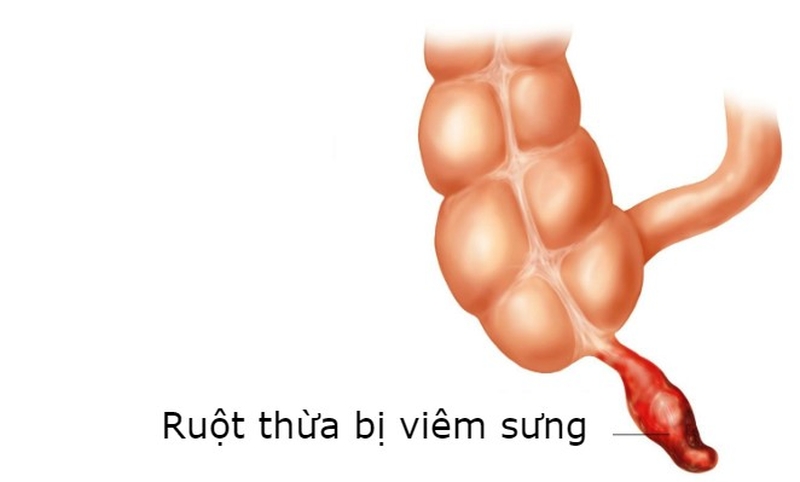 Sau mổ ruột thừa bao lâu thì quan hệ được bình thường? 1
