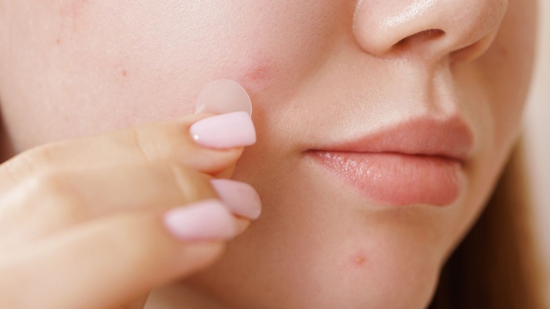 Cẩn trọng với các lưu ý khi dùng miếng dán mụn sau khi nặn mụn
