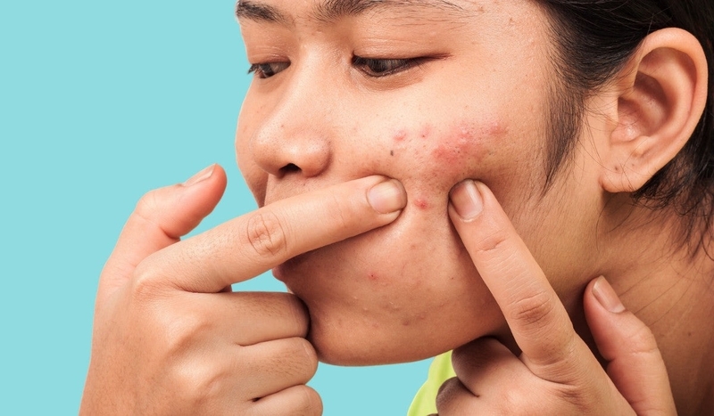 Sau khi nặn mụn có nên rửa mặt bằng nước muối không? -1