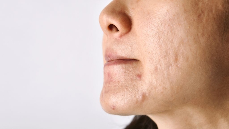 Sau khi nặn mụn nên làm gì? Lưu ý gì khi nặn mụn 1