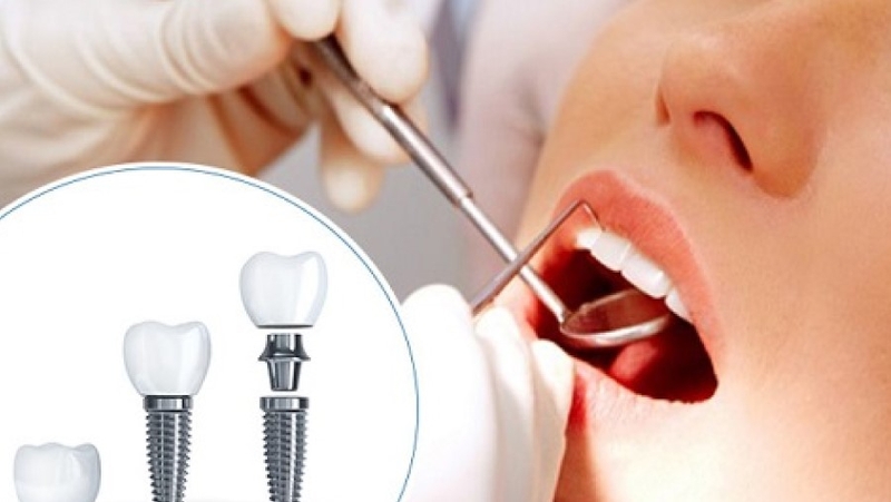 Sau khi nhổ răng bao lâu thì trồng implant là thích hợp? 2