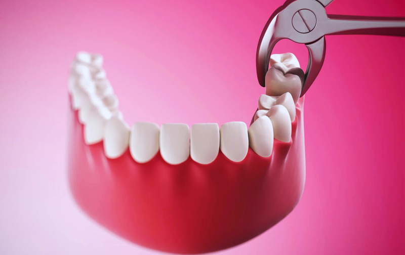 Sau khi nhổ răng mấy tiếng thì được ăn? 5 lưu ý khi chăm sóc răng 1