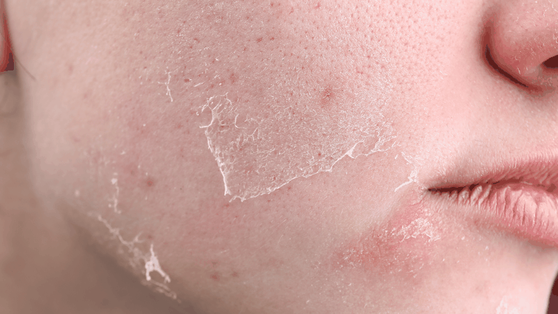 Tình trạng da bong sau peel là tình trạng thường hay bắt gặp đối với dịch vụ chăm sóc da này