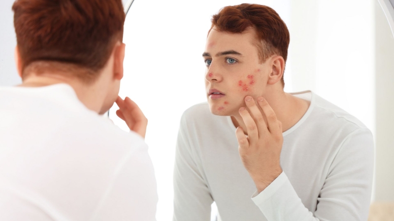 Rửa mặt bằng nước muối giúp hỗ trợ cải thiện mụn trứng cá