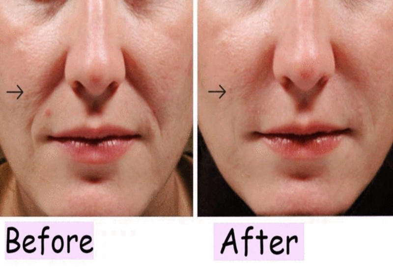 Sau khi tiêm filler rãnh cười cần kiêng gì? 2